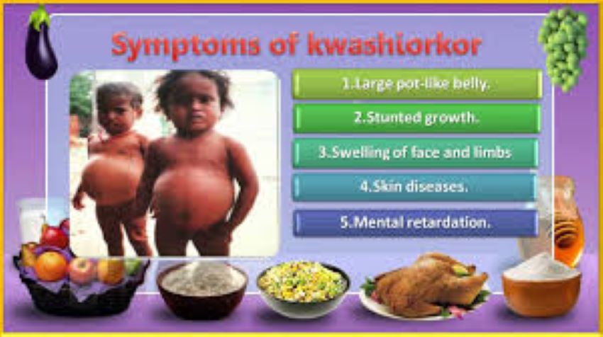 NUTRITION DEFICIENCY DISEASES 1